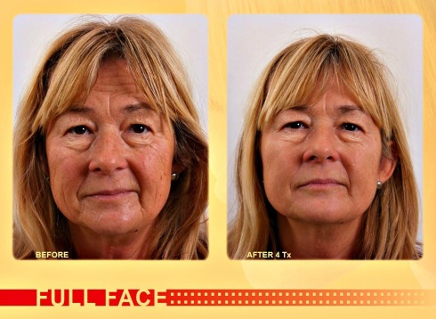 exilis-before-after-5