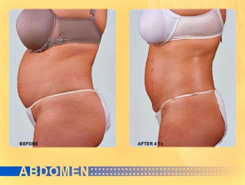 exilis-before-after